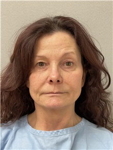 Facelift Before Photo by Arthur Jabs, MD, PhD; Bethesda, MD - Case 49432