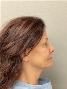 Facelift Before Photo by Arthur Jabs, MD, PhD; Bethesda, MD - Case 49432