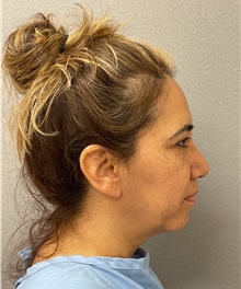 Facelift Before Photo by Arthur Jabs, MD, PhD; Bethesda, MD - Case 49431