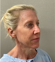 Facelift Before Photo by Arthur Jabs, MD, PhD; Bethesda, MD - Case 49430