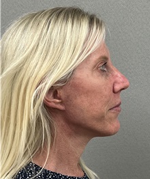 Facelift After Photo by Arthur Jabs, MD, PhD; Bethesda, MD - Case 49430