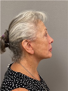 Facelift After Photo by Arthur Jabs, MD, PhD; Bethesda, MD - Case 49436