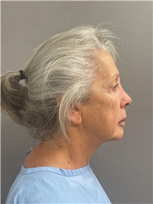 Facelift Before Photo by Arthur Jabs, MD, PhD; Bethesda, MD - Case 49436