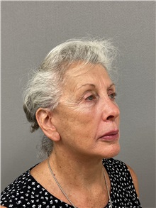 Facelift After Photo by Arthur Jabs, MD, PhD; Bethesda, MD - Case 49436