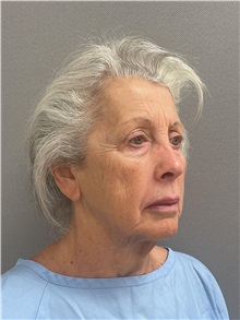 Facelift Before Photo by Arthur Jabs, MD, PhD; Bethesda, MD - Case 49436