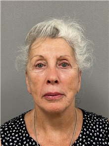 Facelift After Photo by Arthur Jabs, MD, PhD; Bethesda, MD - Case 49436