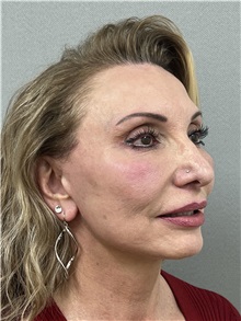 Facelift After Photo by Arthur Jabs, MD, PhD; Bethesda, MD - Case 49444