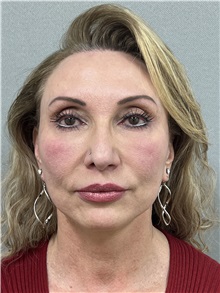 Facelift After Photo by Arthur Jabs, MD, PhD; Bethesda, MD - Case 49444