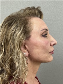 Facelift After Photo by Arthur Jabs, MD, PhD; Bethesda, MD - Case 49444