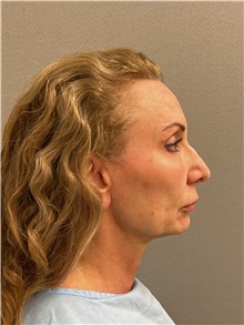 Facelift Before Photo by Arthur Jabs, MD, PhD; Bethesda, MD - Case 49444