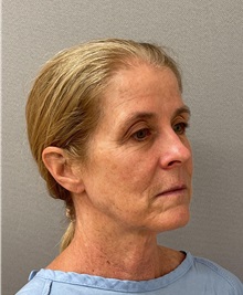 Facelift Before Photo by Arthur Jabs, MD, PhD; Bethesda, MD - Case 49445