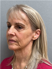 Facelift Before Photo by Arthur Jabs, MD, PhD; Bethesda, MD - Case 49446