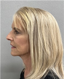 Facelift After Photo by Arthur Jabs, MD, PhD; Bethesda, MD - Case 49446