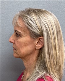 Facelift Before Photo by Arthur Jabs, MD, PhD; Bethesda, MD - Case 49446