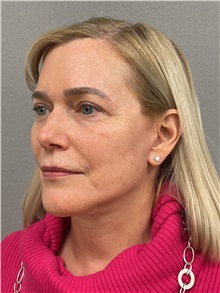 Facelift After Photo by Arthur Jabs, MD, PhD; Bethesda, MD - Case 49450