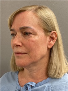 Facelift Before Photo by Arthur Jabs, MD, PhD; Bethesda, MD - Case 49450