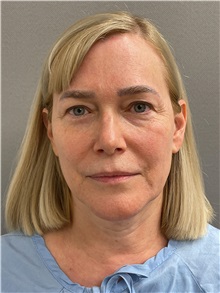 Facelift Before Photo by Arthur Jabs, MD, PhD; Bethesda, MD - Case 49450