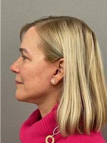 Facelift After Photo by Arthur Jabs, MD, PhD; Bethesda, MD - Case 49450