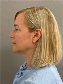 Facelift Before Photo by Arthur Jabs, MD, PhD; Bethesda, MD - Case 49450