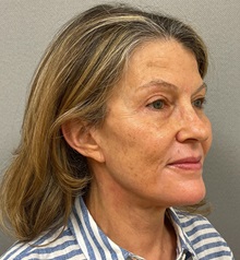 Facelift After Photo by Arthur Jabs, MD, PhD; Bethesda, MD - Case 49448