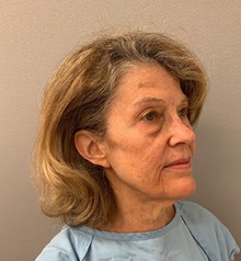 Facelift Before Photo by Arthur Jabs, MD, PhD; Bethesda, MD - Case 49448