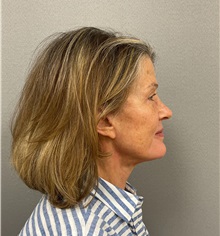 Facelift After Photo by Arthur Jabs, MD, PhD; Bethesda, MD - Case 49448