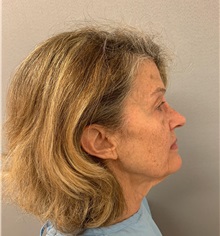 Facelift Before Photo by Arthur Jabs, MD, PhD; Bethesda, MD - Case 49448