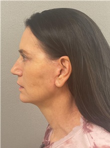 Facelift After Photo by Arthur Jabs, MD, PhD; Bethesda, MD - Case 49451