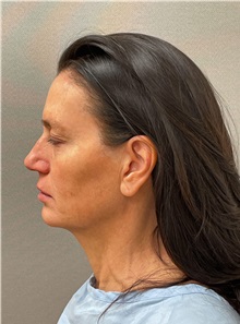 Facelift Before Photo by Arthur Jabs, MD, PhD; Bethesda, MD - Case 49451