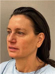 Facelift Before Photo by Arthur Jabs, MD, PhD; Bethesda, MD - Case 49451