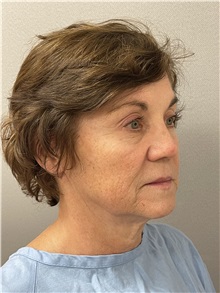 Facelift Before Photo by Arthur Jabs, MD, PhD; Bethesda, MD - Case 49449