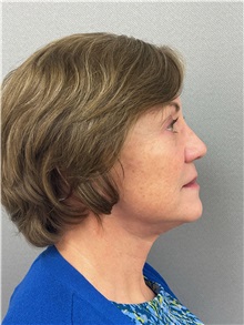 Facelift After Photo by Arthur Jabs, MD, PhD; Bethesda, MD - Case 49449