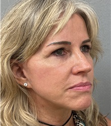Facelift After Photo by Arthur Jabs, MD, PhD; Bethesda, MD - Case 49452