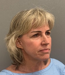 Facelift Before Photo by Arthur Jabs, MD, PhD; Bethesda, MD - Case 49452
