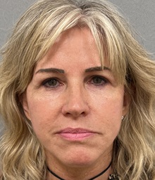 Facelift After Photo by Arthur Jabs, MD, PhD; Bethesda, MD - Case 49452
