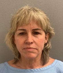 Facelift Before Photo by Arthur Jabs, MD, PhD; Bethesda, MD - Case 49452