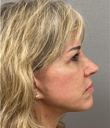 Facelift After Photo by Arthur Jabs, MD, PhD; Bethesda, MD - Case 49452