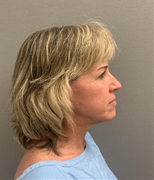 Facelift Before Photo by Arthur Jabs, MD, PhD; Bethesda, MD - Case 49452
