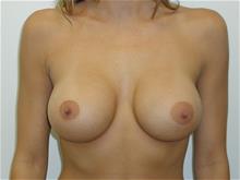 Breast Augmentation After Photo by Robert Herbstman, MD, FACS; East Brunswick, NJ - Case 29371