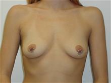 Breast Augmentation Before Photo by Robert Herbstman, MD, FACS; East Brunswick, NJ - Case 29371