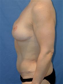 Tummy Tuck After Photo by Robert Herbstman, MD, FACS; East Brunswick, NJ - Case 29372