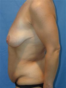 Tummy Tuck Before Photo by Robert Herbstman, MD, FACS; East Brunswick, NJ - Case 29372