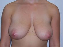 Breast Reduction Before Photo by Robert Herbstman, MD, FACS; East Brunswick, NJ - Case 29373