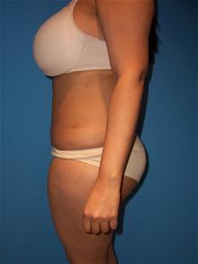 Liposuction After Photo by Robert Herbstman, MD, FACS; East Brunswick, NJ - Case 29376