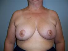 Breast Reduction After Photo by Robert Herbstman, MD, FACS; East Brunswick, NJ - Case 29378