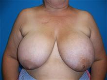 Breast Reduction Before Photo by Robert Herbstman, MD, FACS; East Brunswick, NJ - Case 29378