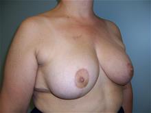 Breast Reduction After Photo by Robert Herbstman, MD, FACS; East Brunswick, NJ - Case 29378