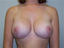 Breast Lift After Photo by Robert Herbstman, MD, FACS; East Brunswick, NJ - Case 29383