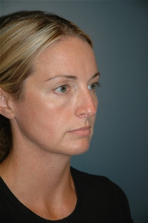 Rhinoplasty Before Photo by Richard Rand, MD; Bellevue, WA - Case 21999