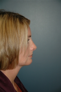 Rhinoplasty After Photo by Richard Rand, MD; Bellevue, WA - Case 21999